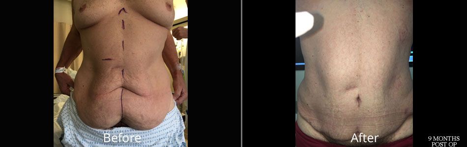 tss-full-panniculectomy-before-&-afters2