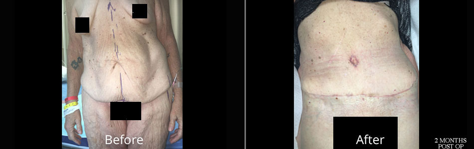 tss-full-panniculectomy-before-&-afters3